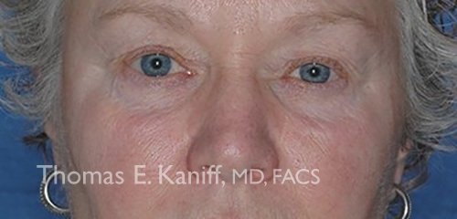 Patient 1122_front_before_eyelid - 500x240 - WM