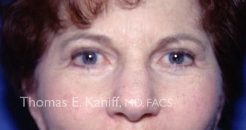 Patient 1133_front_after_eyelid - 500X265 - WM