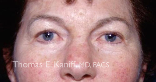 Patient 1133_front_before_eyelid - 500x265 - WM
