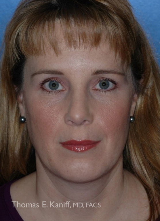 Patient 1285_Chin Implant_After_Center - 556x768 WM