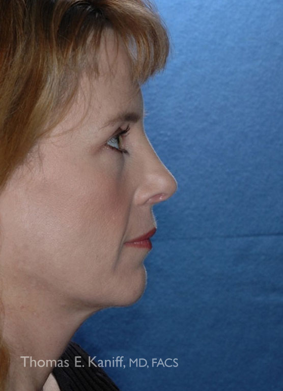 Patient 1285_Chin Implant_After_Side_556x768 - WM