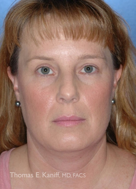 Patient 1285_Chin Implant_Before_Center_556x768 - WM