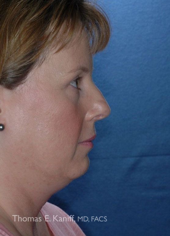 Patient 1285_Chin Implant_Before_Side_556x768-WM