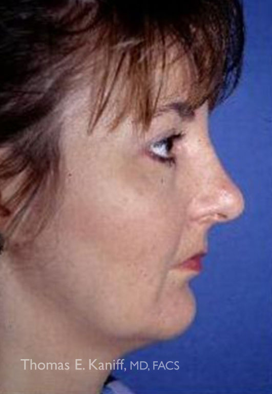 Patient 1295_Chin Implant_After_Side_531x768-WM