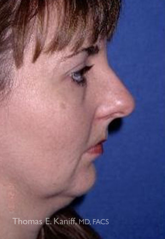 Patient 1295_Chin Implant_Before_Side - 531x768 - WM