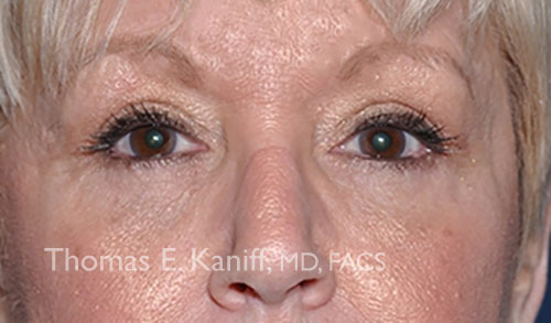 Patient 1306_front_after_eyelid - 500x293 - WM