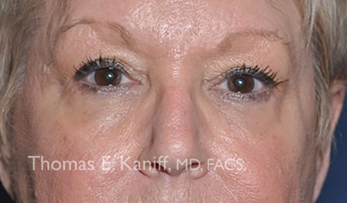Patient 1306_front_before_eyelid - 500x293 - WM
