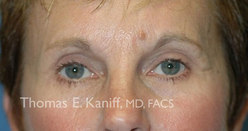 Patient 1108-2_front_after_eyelid - 500x265 - WM