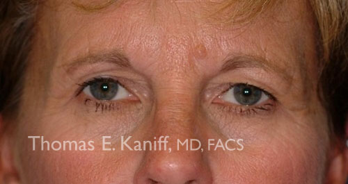 Patient 1108-2_front_before_eyelid - 500x265 - WM