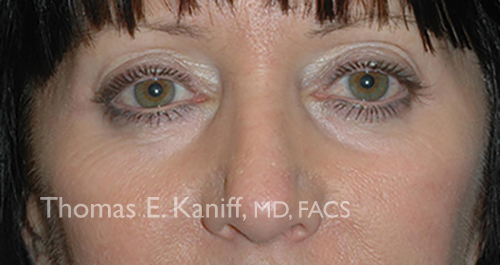 Patient 1310_front_after_eyelid - 500x265 - WM
