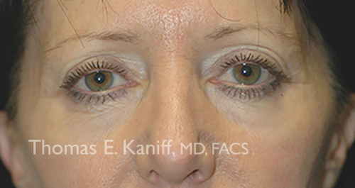 Patient 1310_front_before_eyelid - 500x265 - WM