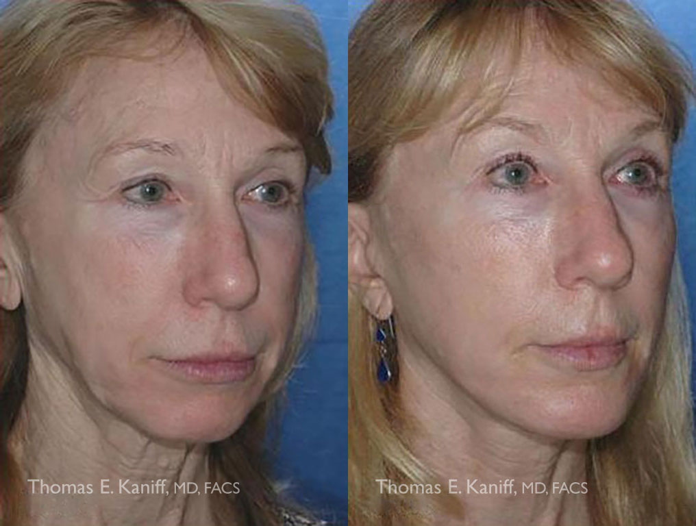 1135 Facelift, Chin Implant and Sculptra Series