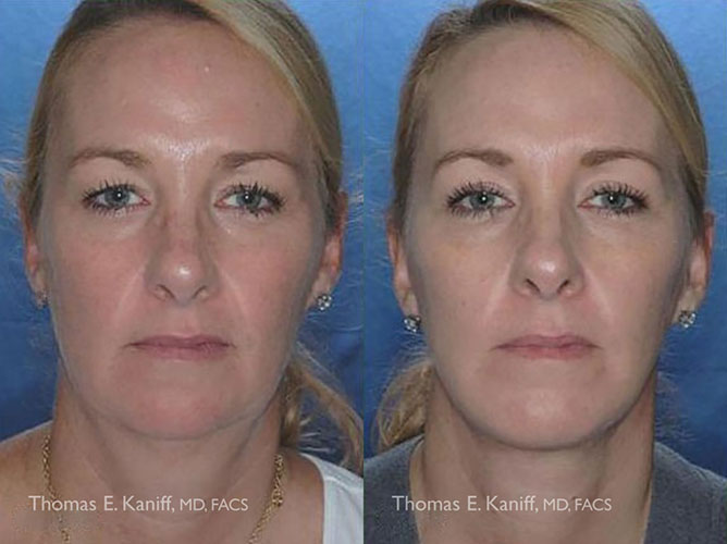 1142 Facelift, Blepharoplasty and Chin Implant