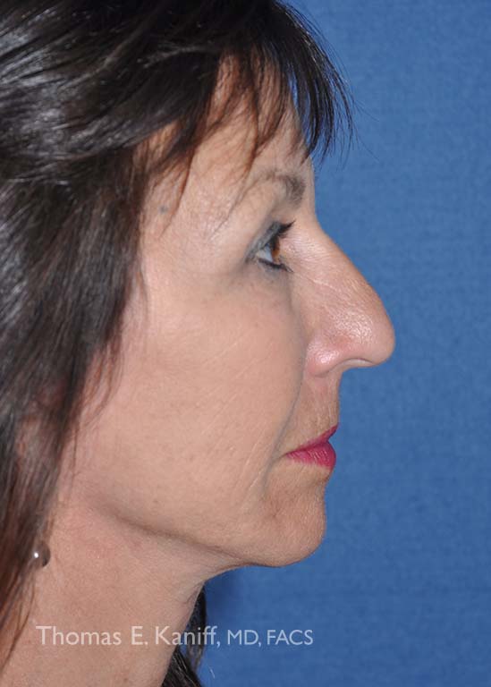 Patient 2064_right side after-549x768-WM