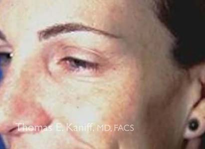 Patient 4120_Botox_After_411x300-WM