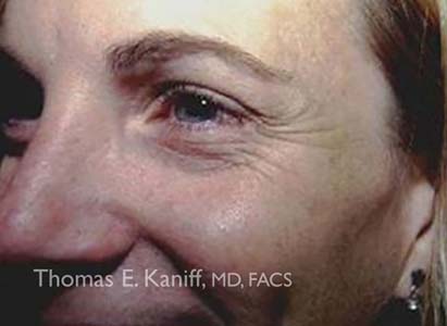 Patient 4120_Botox_Before_411x300-WM