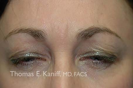 Patient 4130_Botox_After_454x300-WM