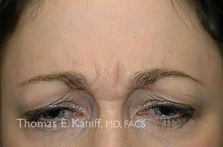 Patient 4130_Botox_Before_454x300-WM