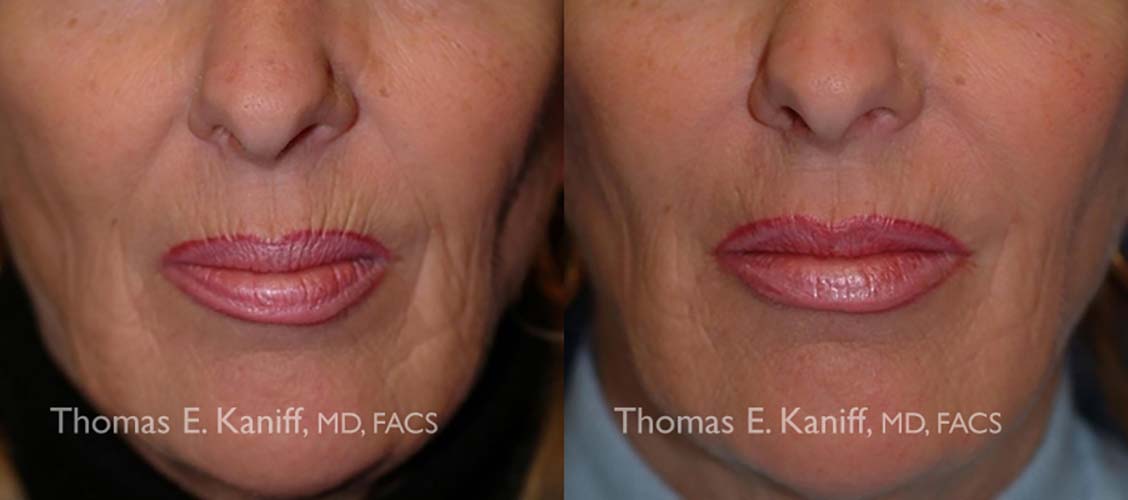 4225 Filler to the Nasolabial Folds and Marionette Area