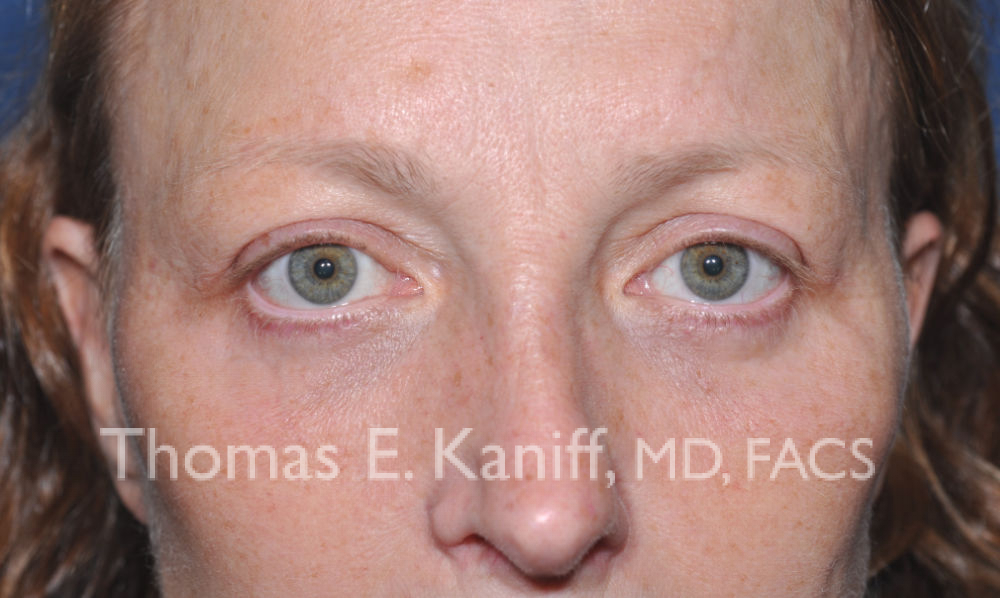 KP eyes after