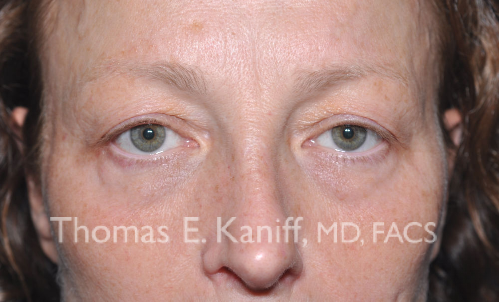 KP eyes before