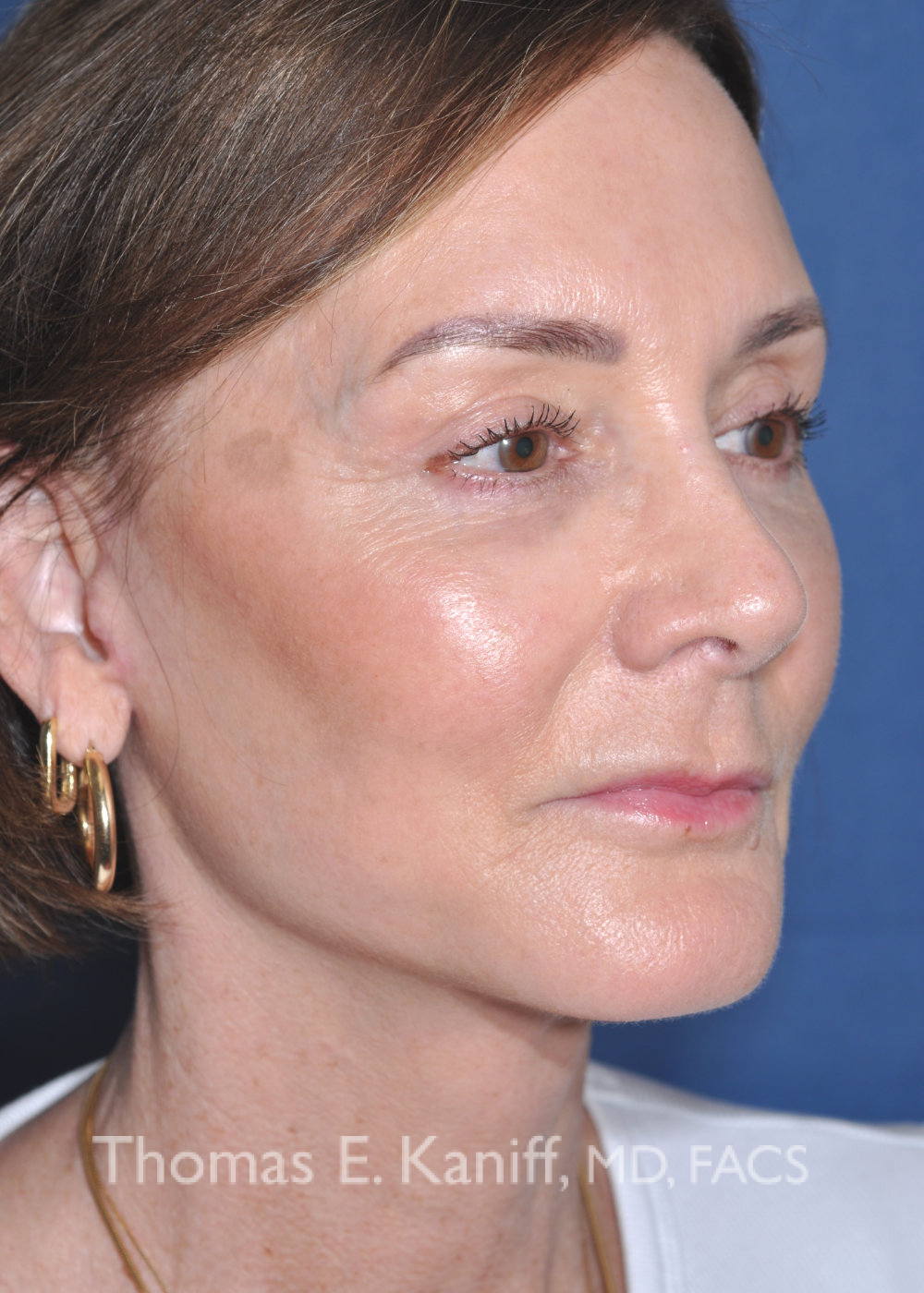 Deep plane facelift Sacramento after oblique view