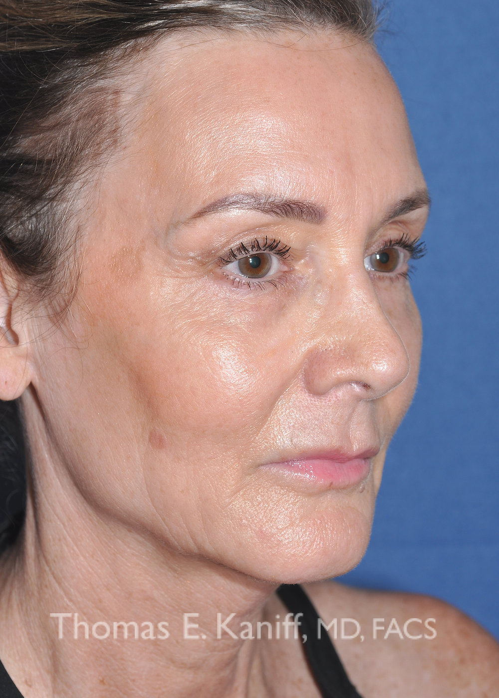 Deep plane facelift Sacramento before oblique view