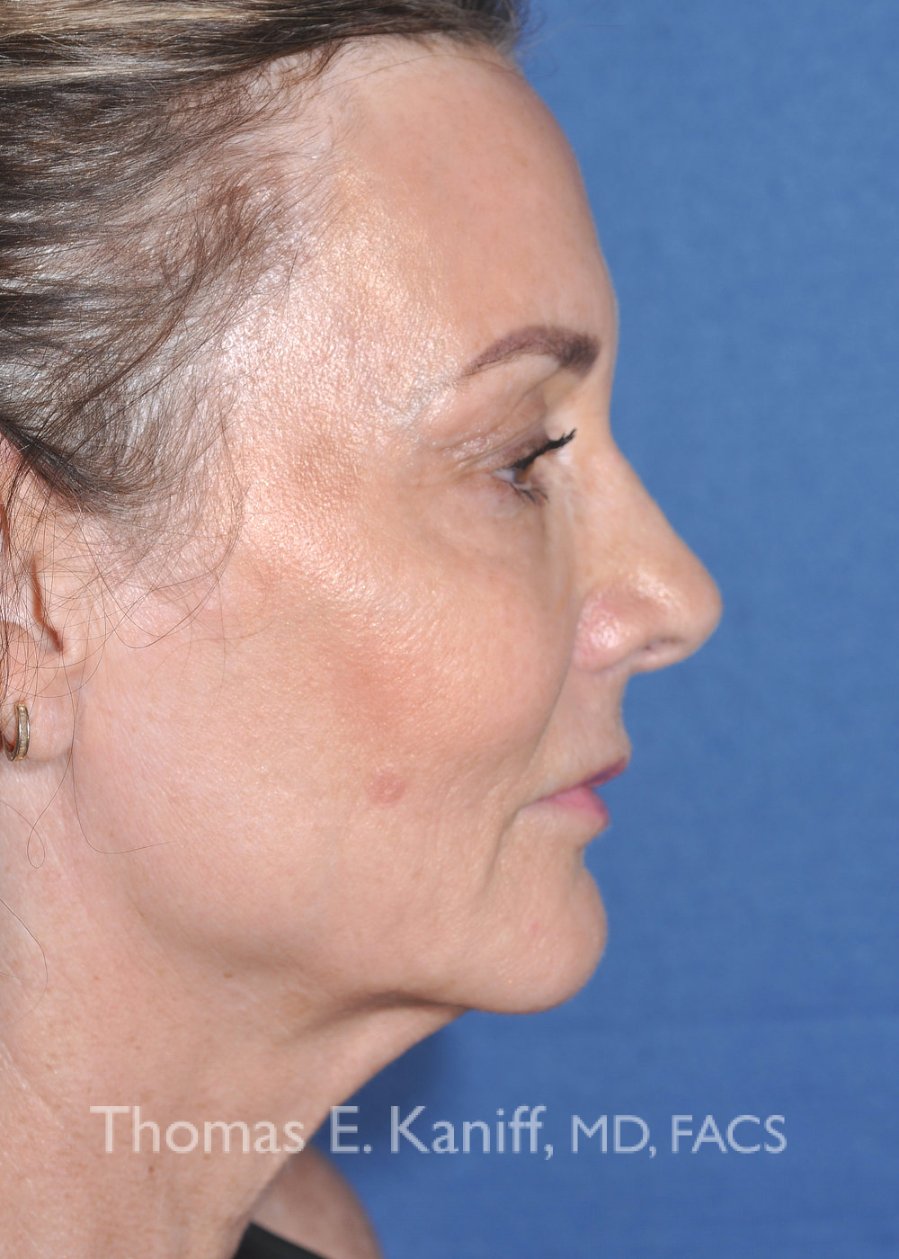 Deep plane facelift Sacramento before side view