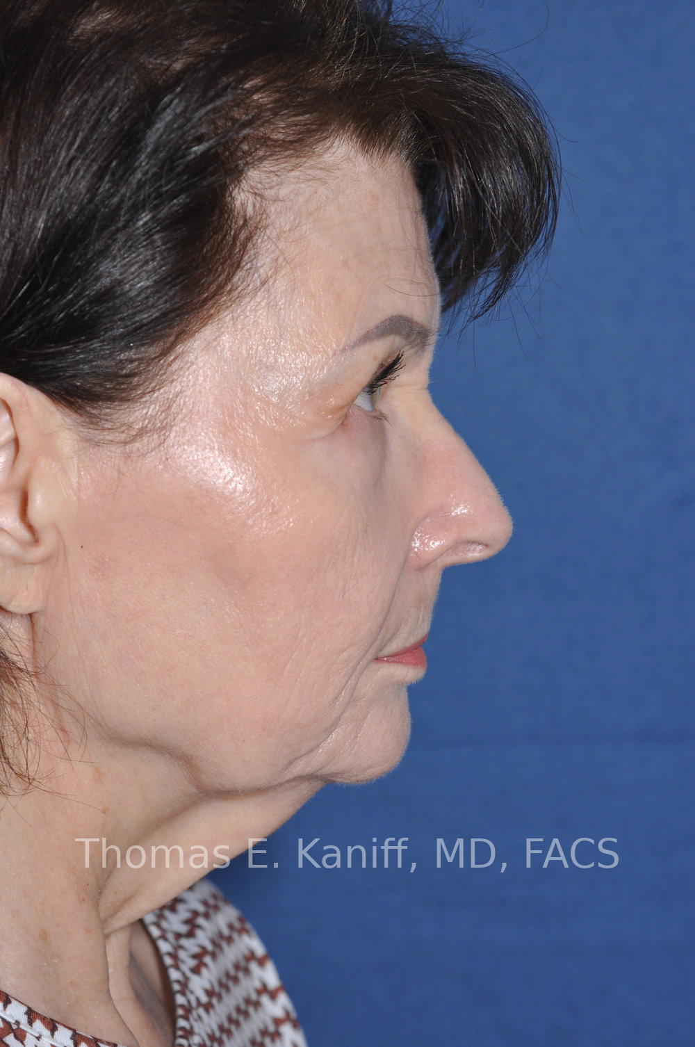 Deep Plane Facelift, Deep Plane Neck Lift, Lower Eyelid Surgery, Fat Transfer, and Laser Resurfacing before side view