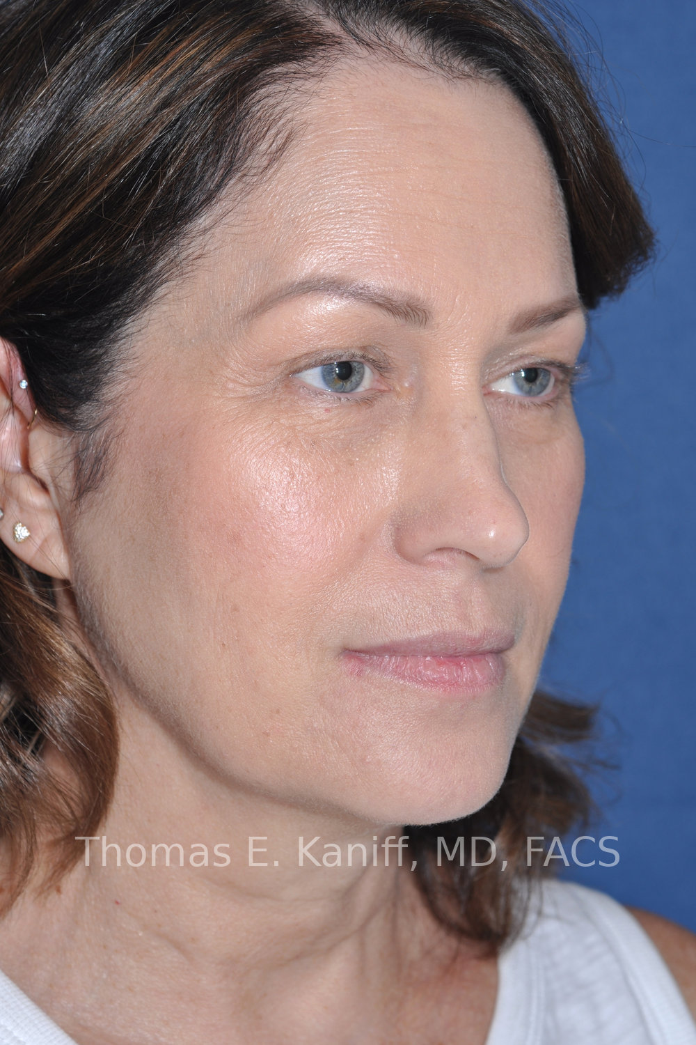 Deep Plane Facelift, Deep Plane Neck Lift, Fat Transfer and Laser Resurfacing before oblique view