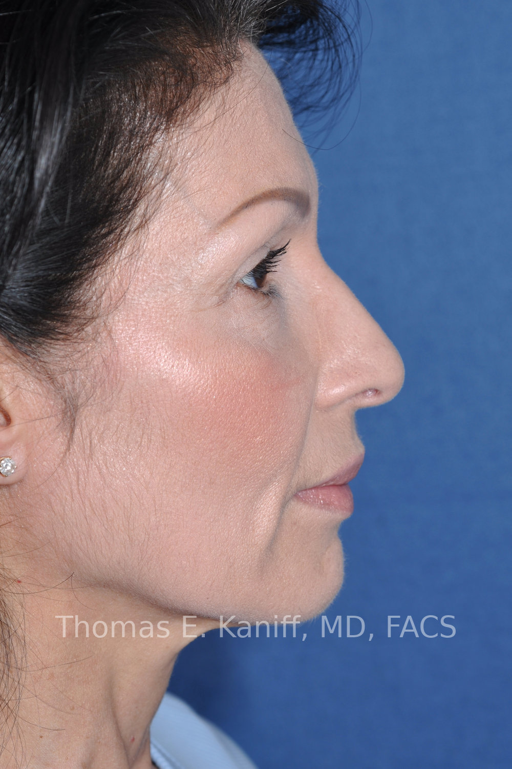 Deep Plane Facelift and Rhinoplasty before side view