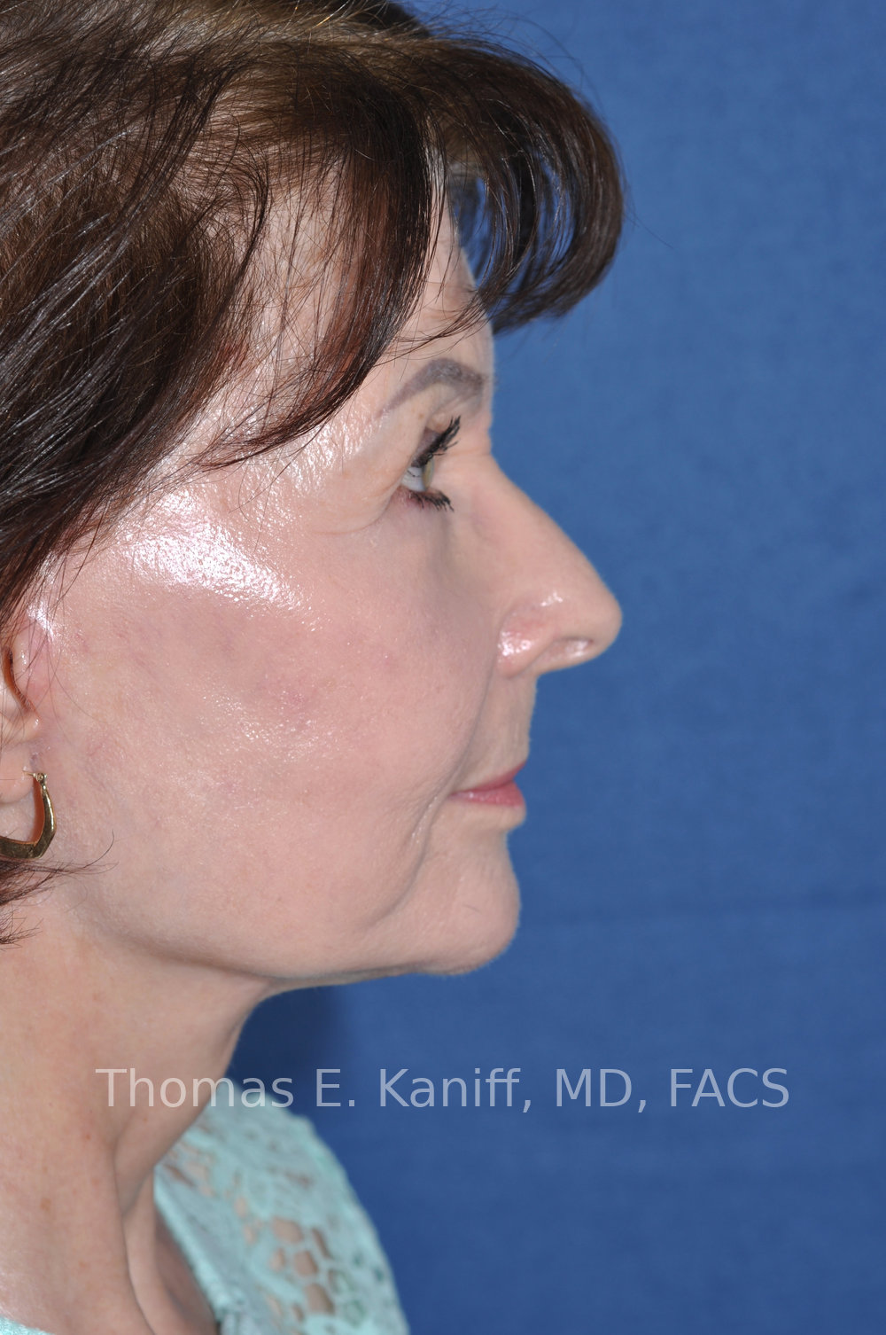 Deep Plane Facelift, Deep Plane Neck Lift, Lower Eyelid Surgery, Fat Transfer, and Laser Resurfacing after side view