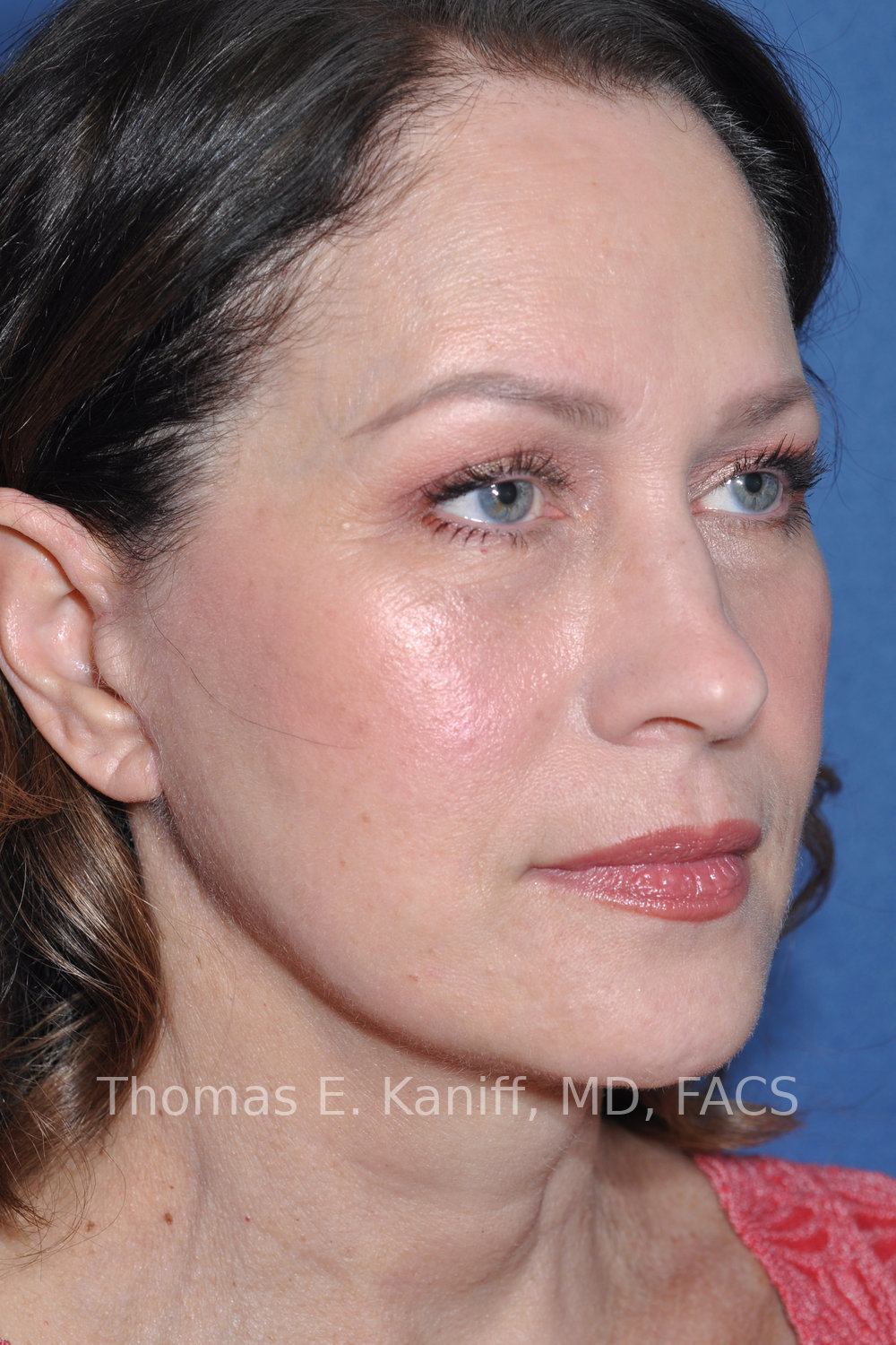 Deep Plane Facelift, Deep Plane Neck Lift, Fat Transfer and Laser Resurfacing after oblique view