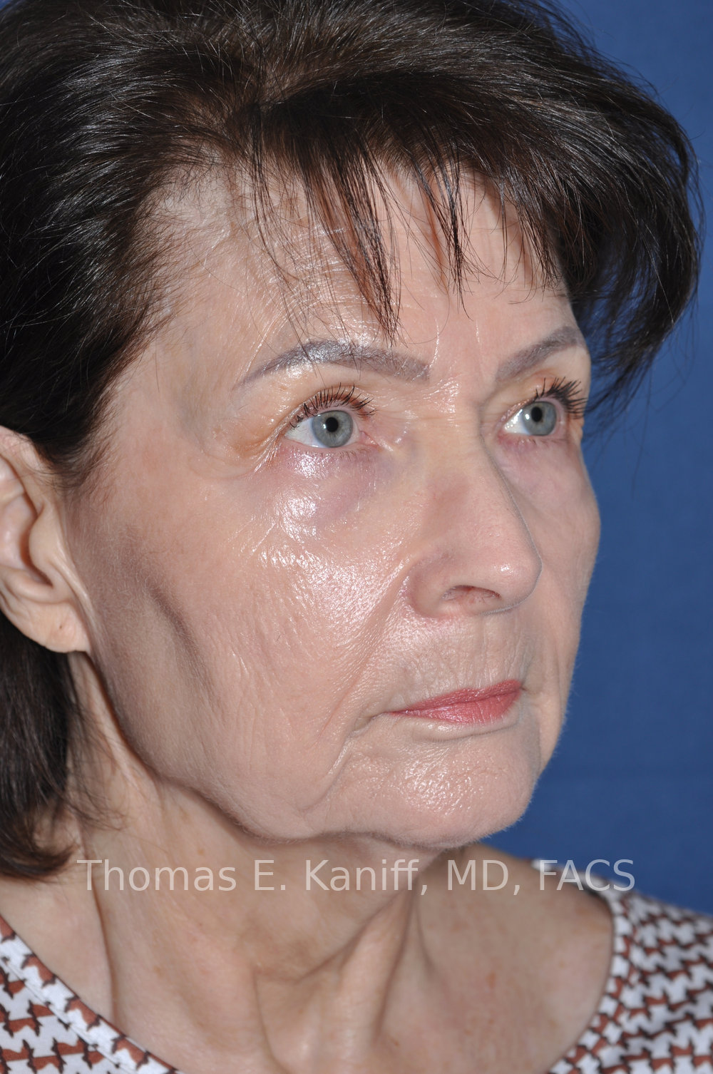 Deep Plane Facelift, Deep Plane Neck Lift, Lower Eyelid Surgery, Fat Transfer and Laser Resurfacing before oblique view