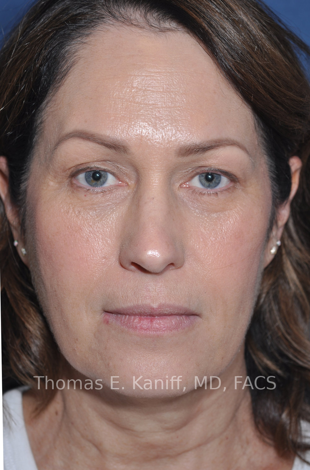 Deep Plane Facelift, Deep Plane Neck Lift, Fat Transfer and Laser Resurfacing before view