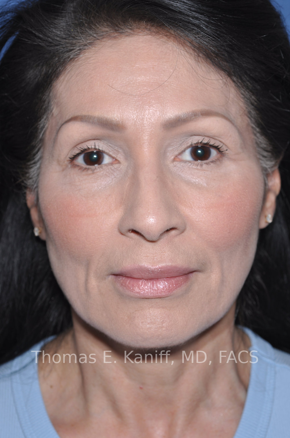 Deep Plane Facelift and Rhinoplasty before front view