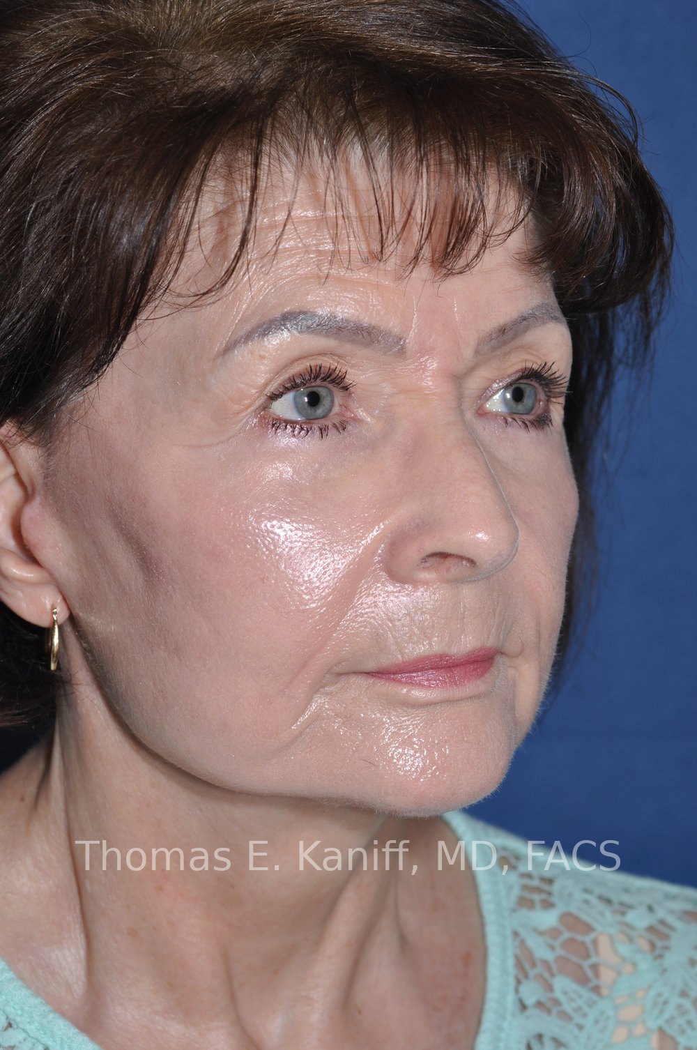 Deep Plane Facelift, Deep Plane Neck Lift, Lower Eyelid Surgery, Fat Transfer and Laser Resurfacing after oblique view