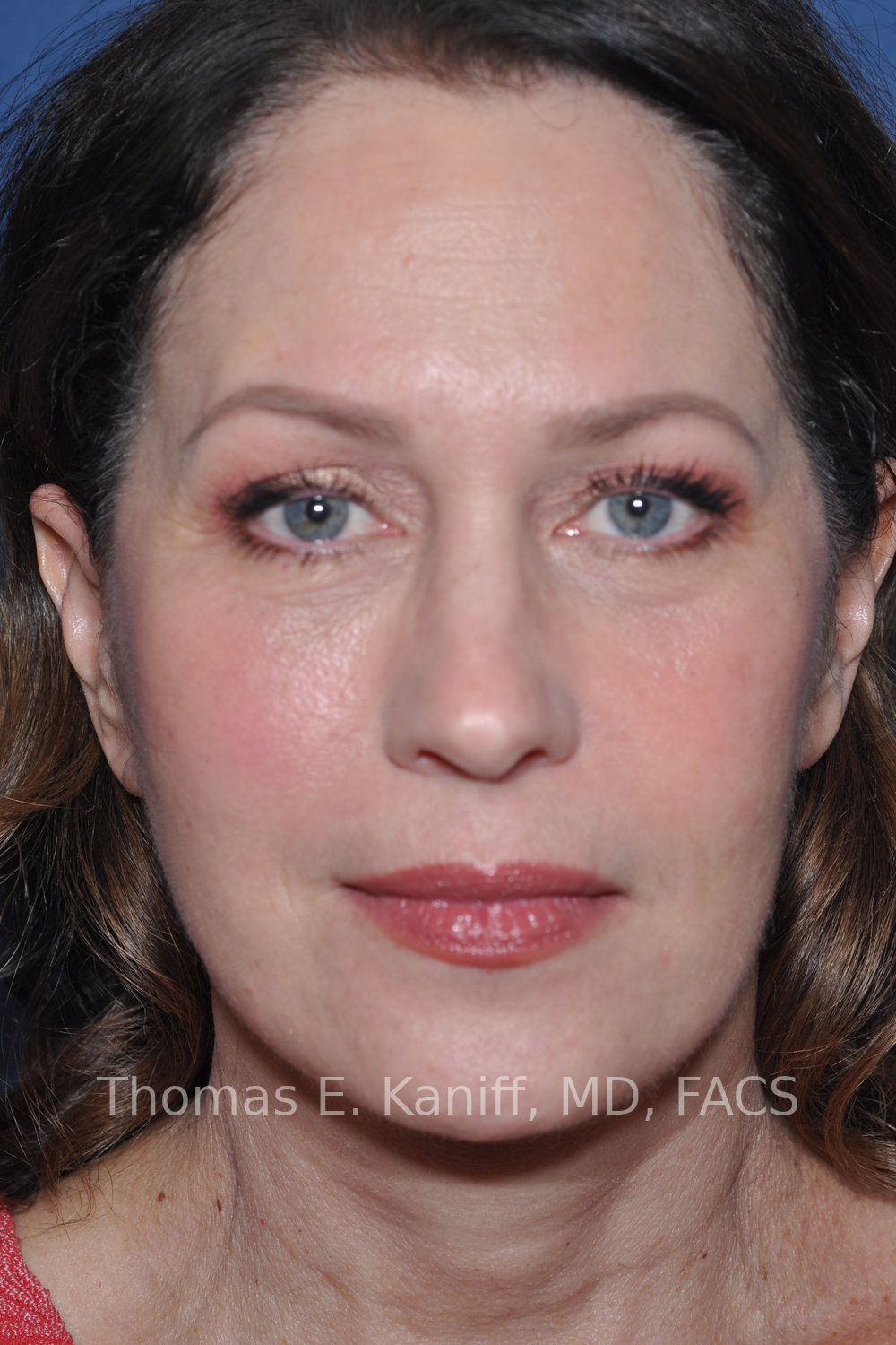 Deep Plane Facelift, Deep Plane Neck Lift, Fat Transfer and Laser Resurfacing after front view