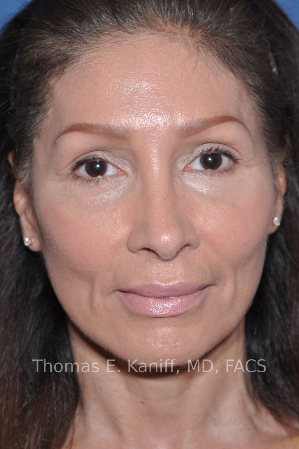 Deep Plane Facelift and Rhinoplasty after front view