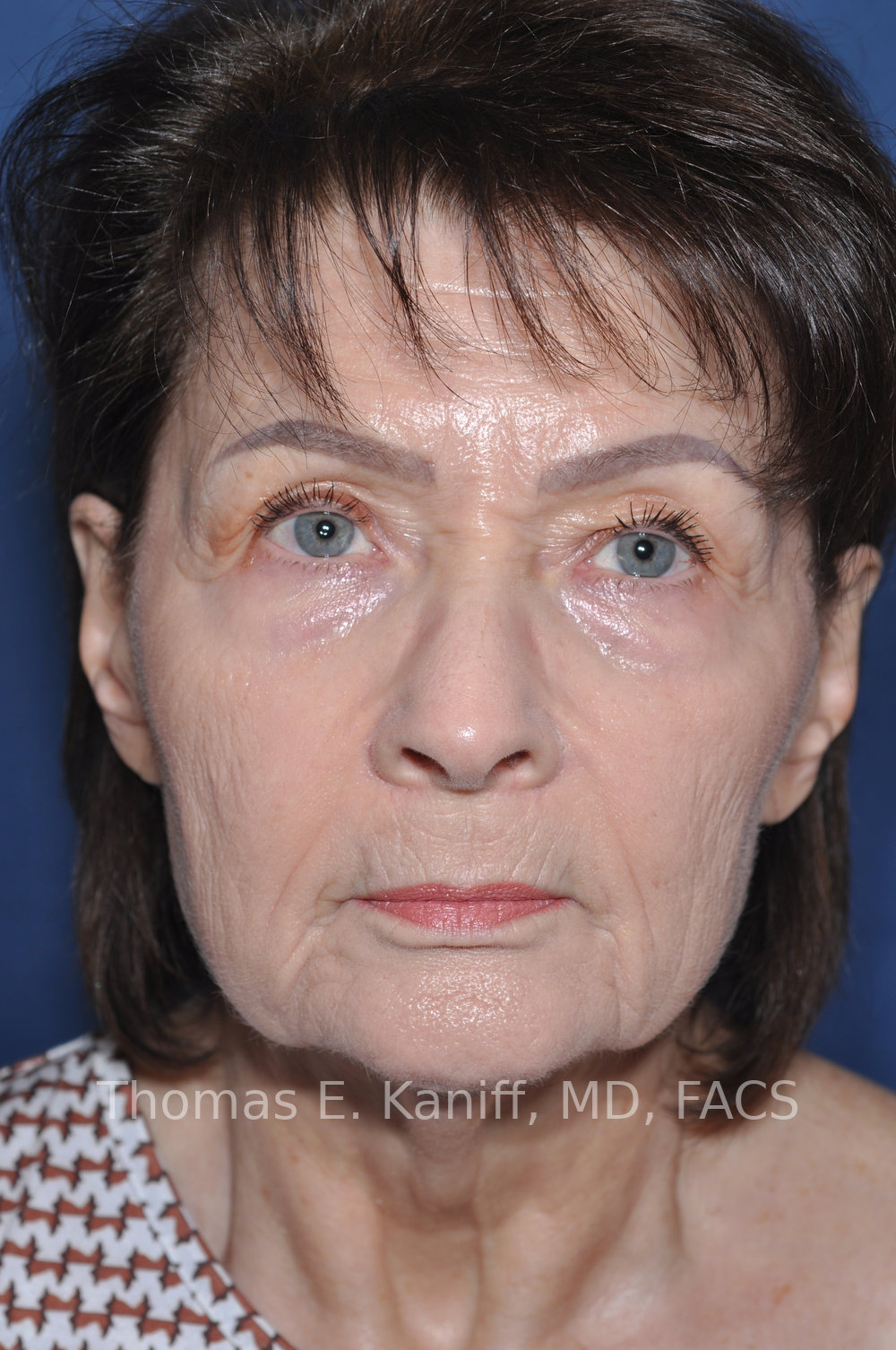Deep Plane Facelift, Deep Plane Neck Lift, Lower Eyelid Surgery, Fat Transfer and Laser Resurfacing before front view
