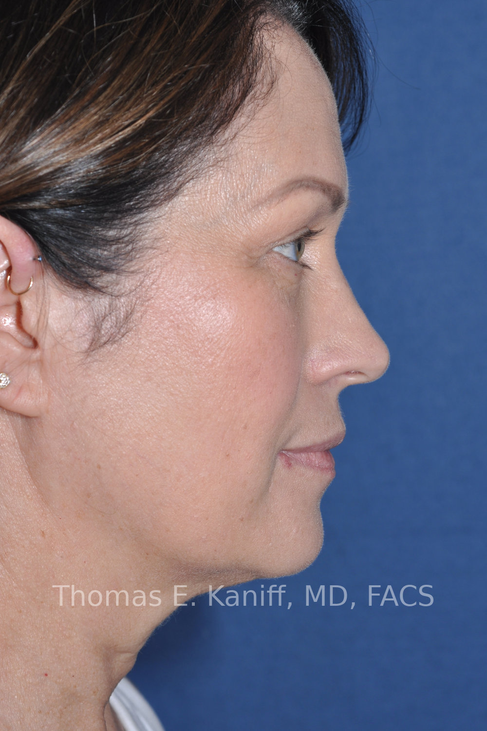 Deep Plane Facelift, Deep Plane Neck Lift, Fat Transfer, and Laser Resurfacing before side view