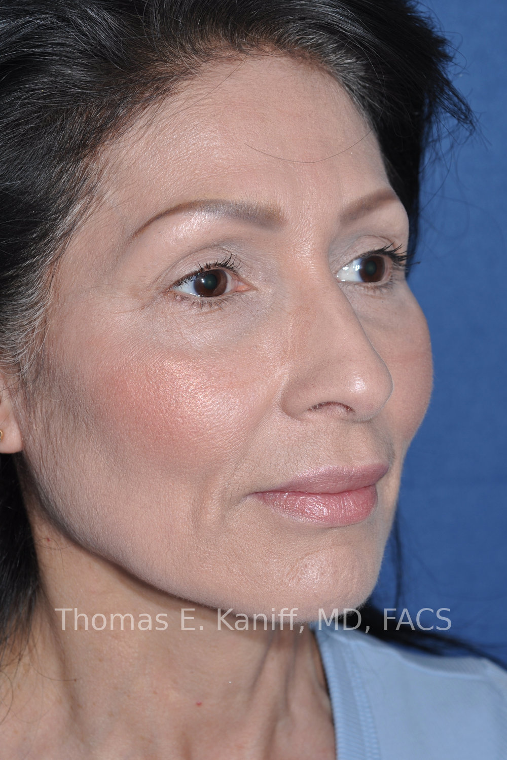 Deep Plane Facelift and Rhinoplasty before oblique view