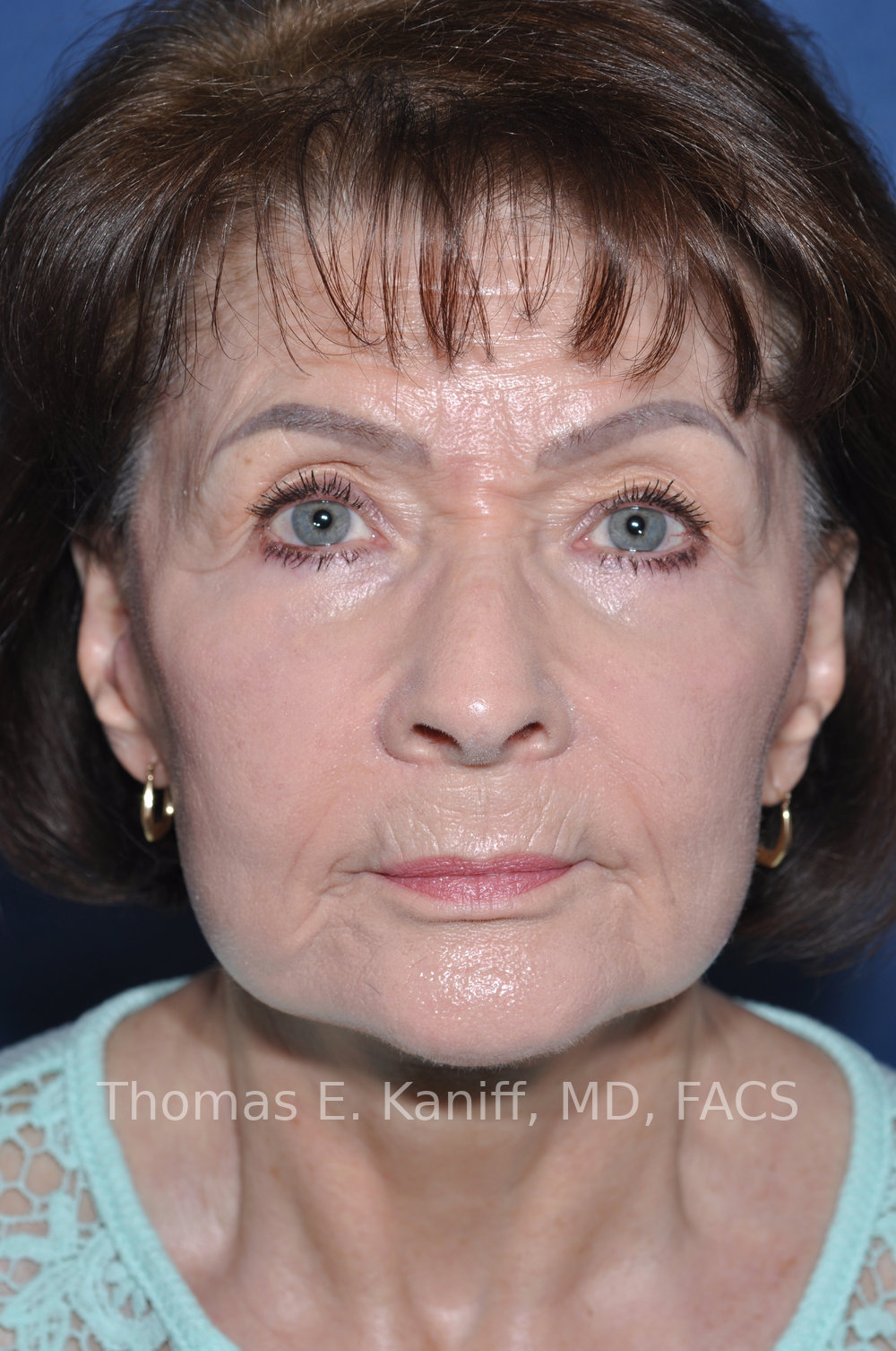 Deep Plane Facelift, Deep Plane Neck Lift, Lower Eyelid Surgery, Fat Transfer, and Laser Resurfacing after front view