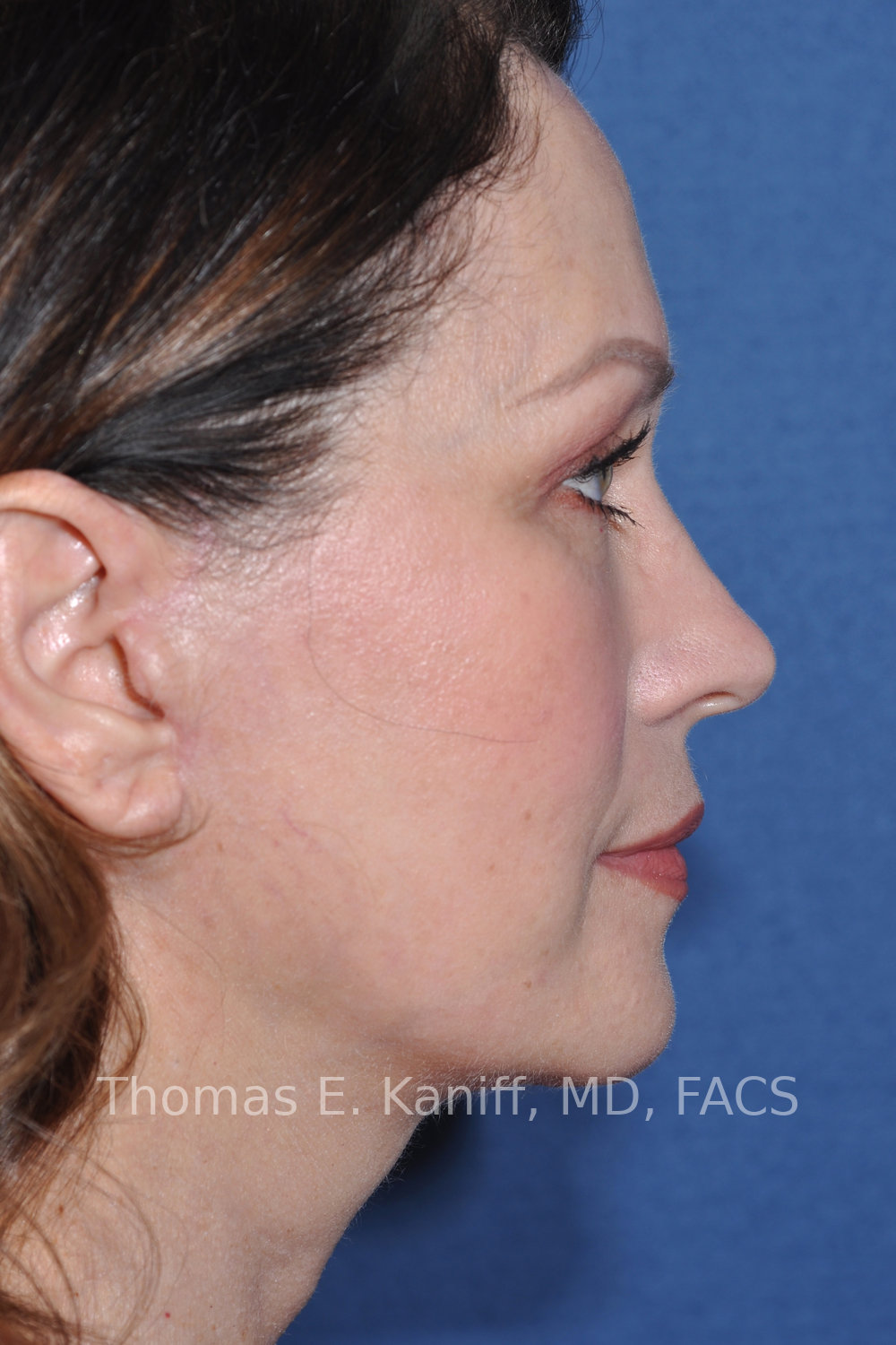 Deep Plane Facelift, Deep Plane Neck Lift, Fat Transfer, and Laser Resurfacing after side view