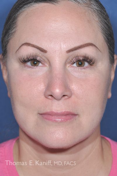 Front profile after patient has received deep plane facial treatment resulting in enhanced cheek volume and lower face contour