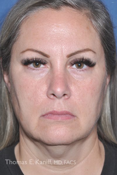 Front profile of patient prior to receiving deep plane facelift