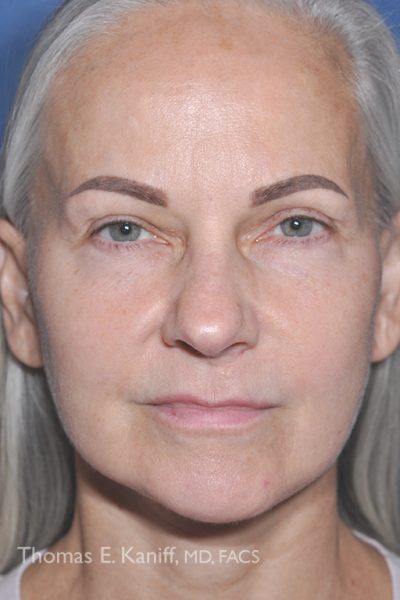 Front profile of patient after receiving deep plane facial treatment resulting in improved jawline adn reduced jowles