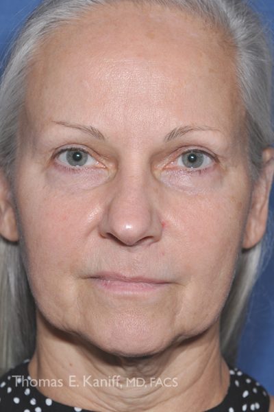 Front profile of patient prior to receiving deep plane facial treatment