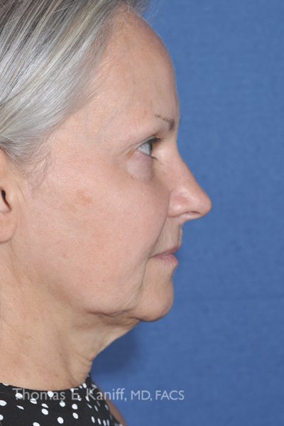 Patient before chin and cheek augmentation showing weak chin and flat cheeks
