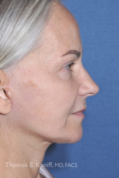 Patient after chin and cheek augmentation with a stronger chin and fuller cheeks